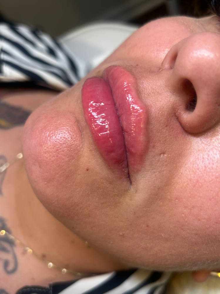 1.5ML (noticeable Plump)