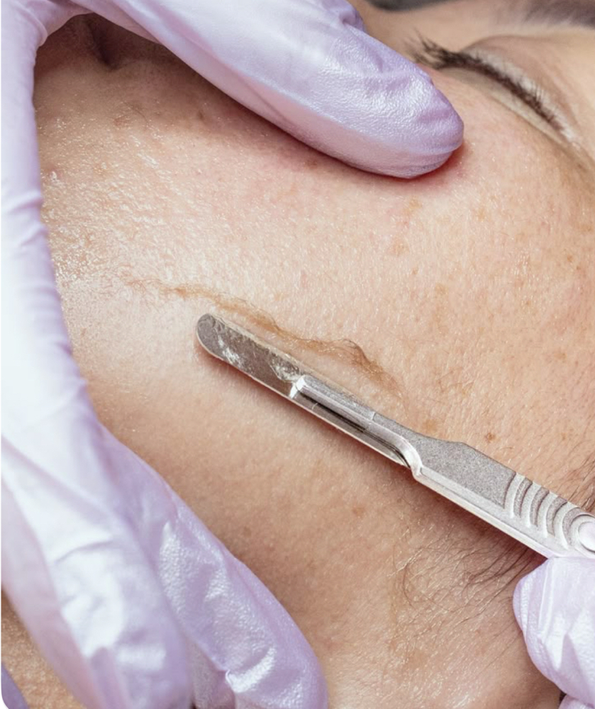 Dermaplane Facial