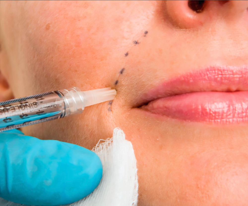 Dermal Filler