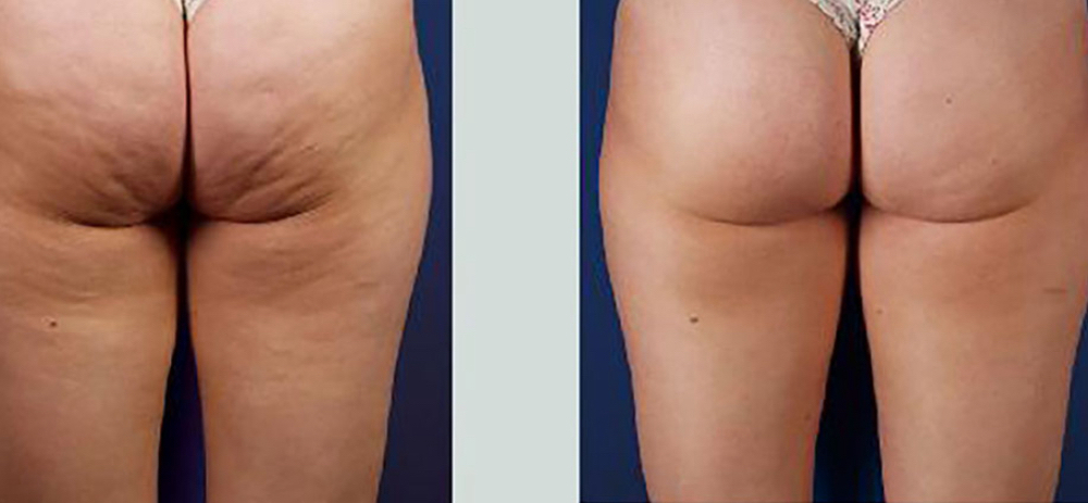 Cellulite  Treatment