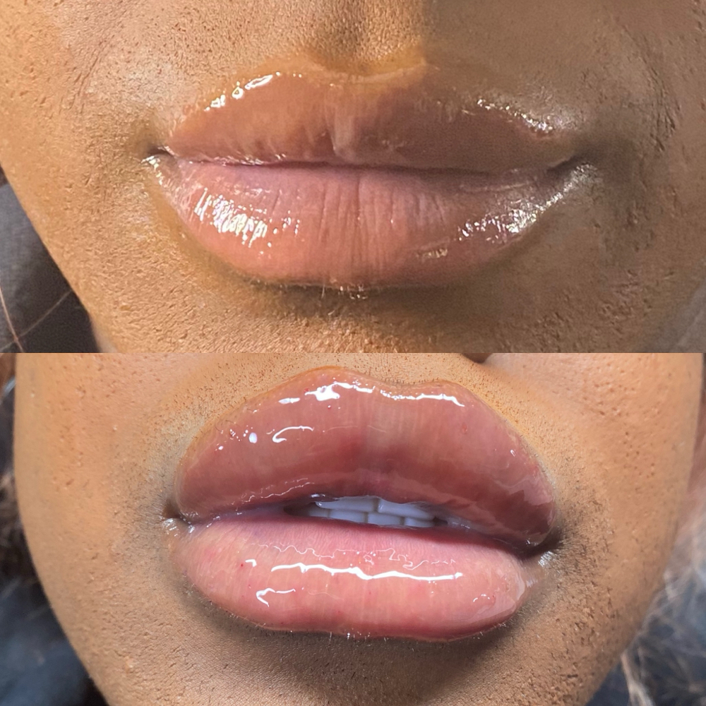 💖Lavish Lip Fillers 💉❌👄💖