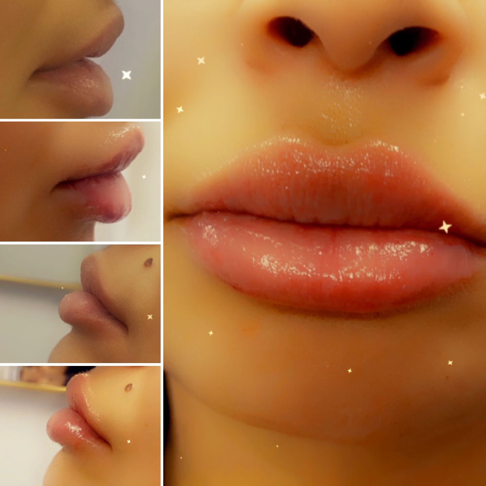 1session Lip Filler Up To 1ml