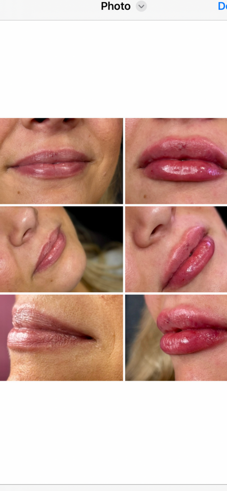 Lip Filler $550