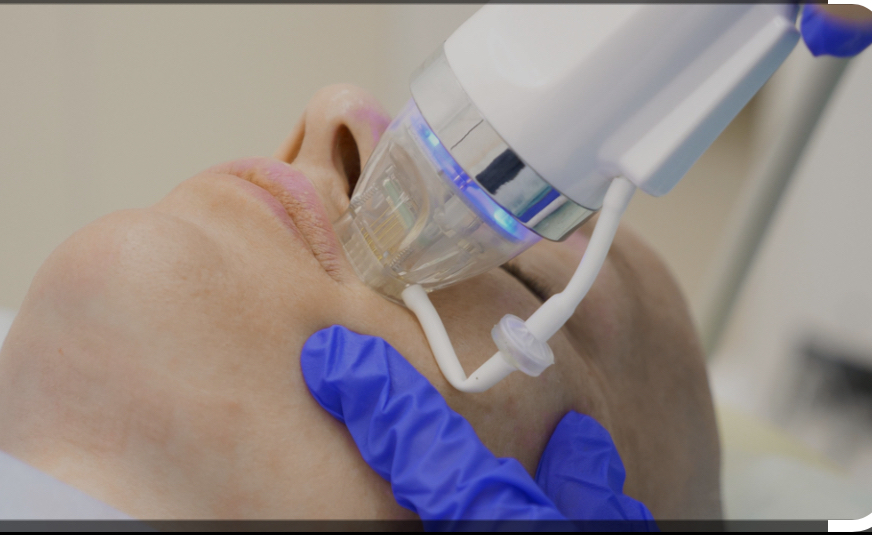 RF Microneedling Skin Tightening