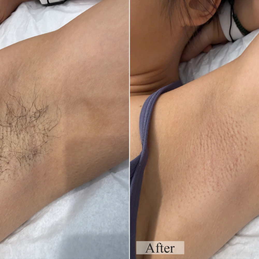Underarms at The Pink Beauty Lab in Lakeland, FL