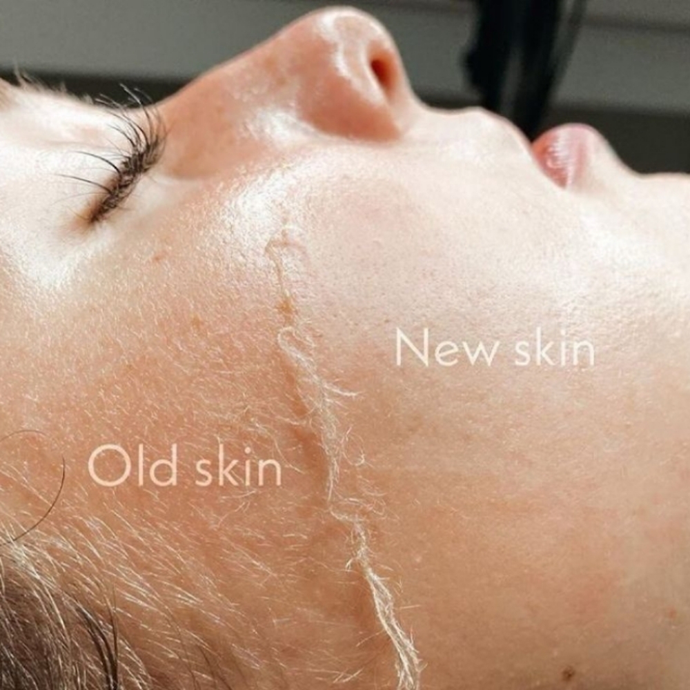 Dermaplaning at Glam & Glow MedSpa in Plano, TX