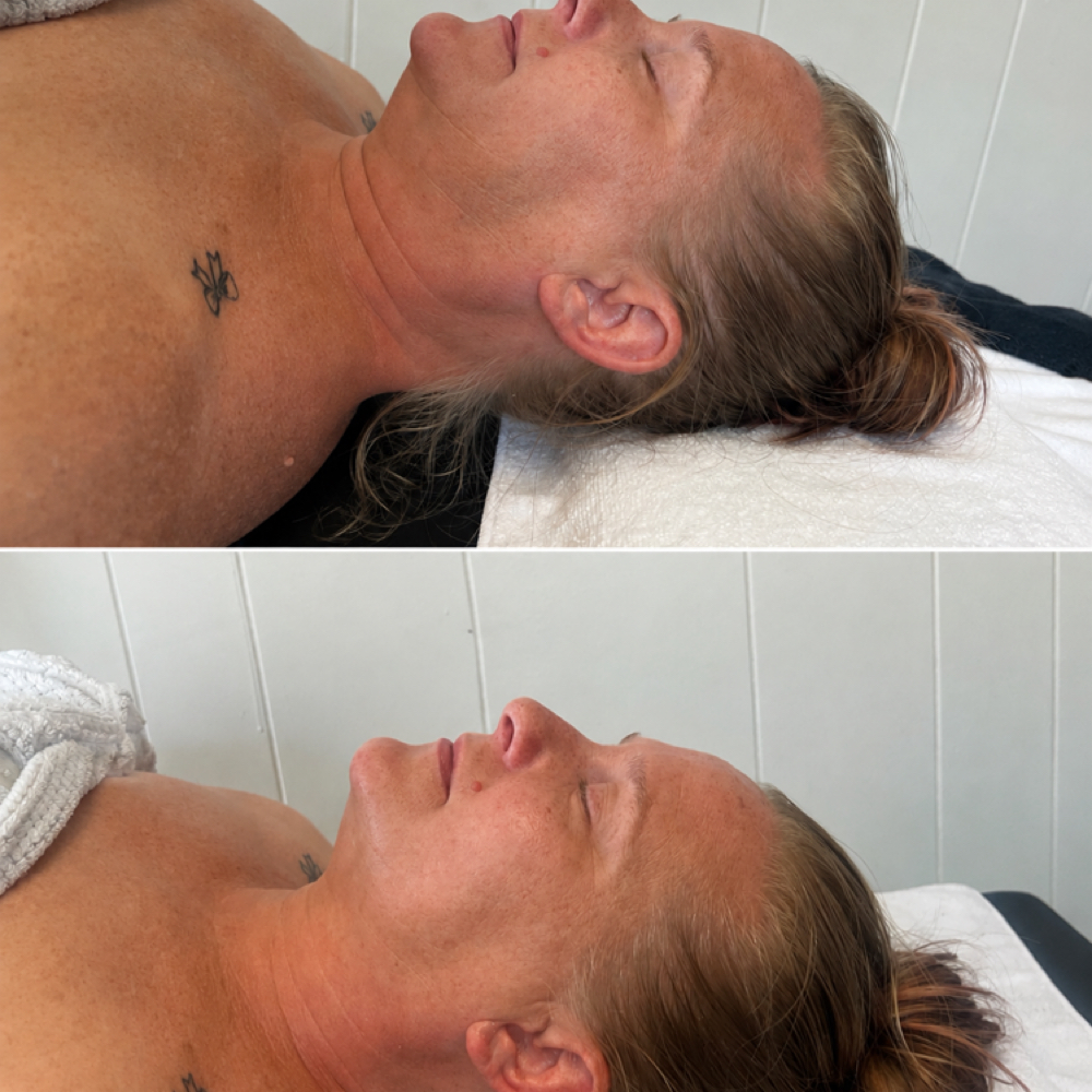 RF (radio Frequency) Facial at MRG Beauty Bar in Fremont, OH