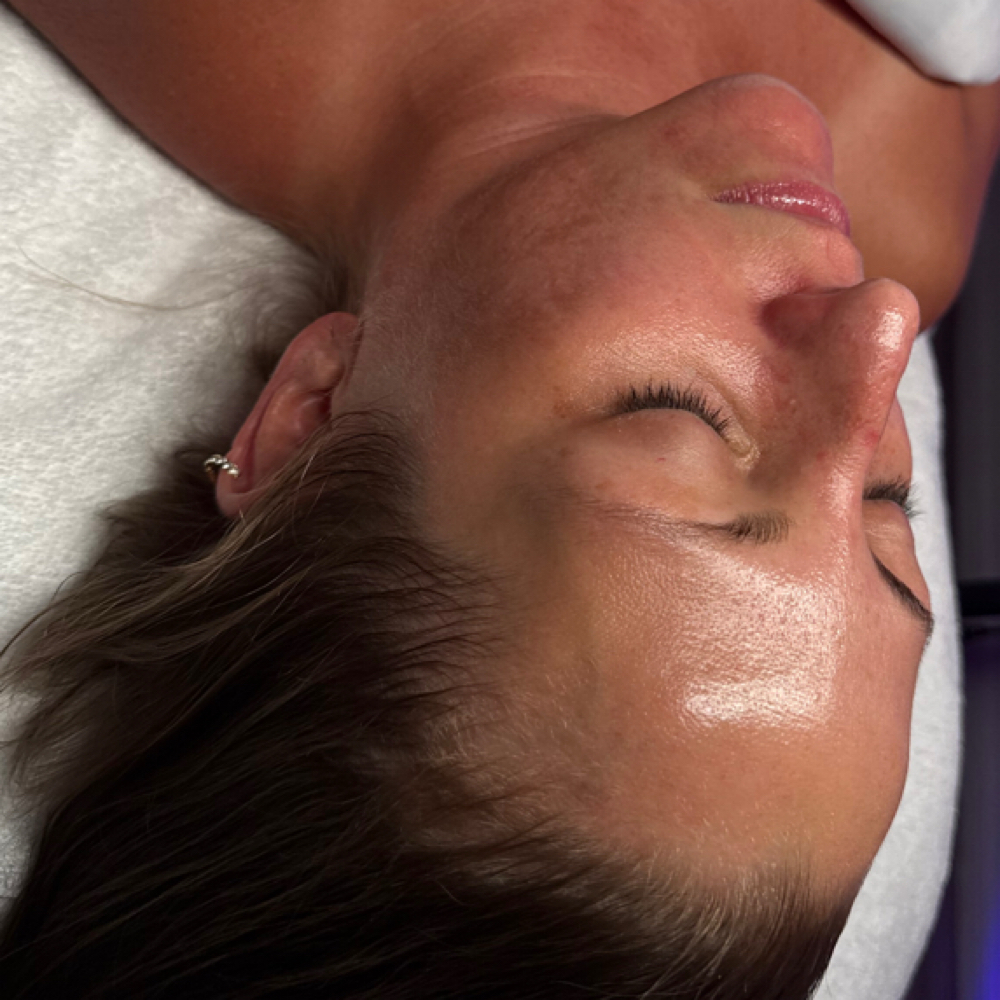 Melapro Brightening Peel at EstheticsHD in Naples, FL