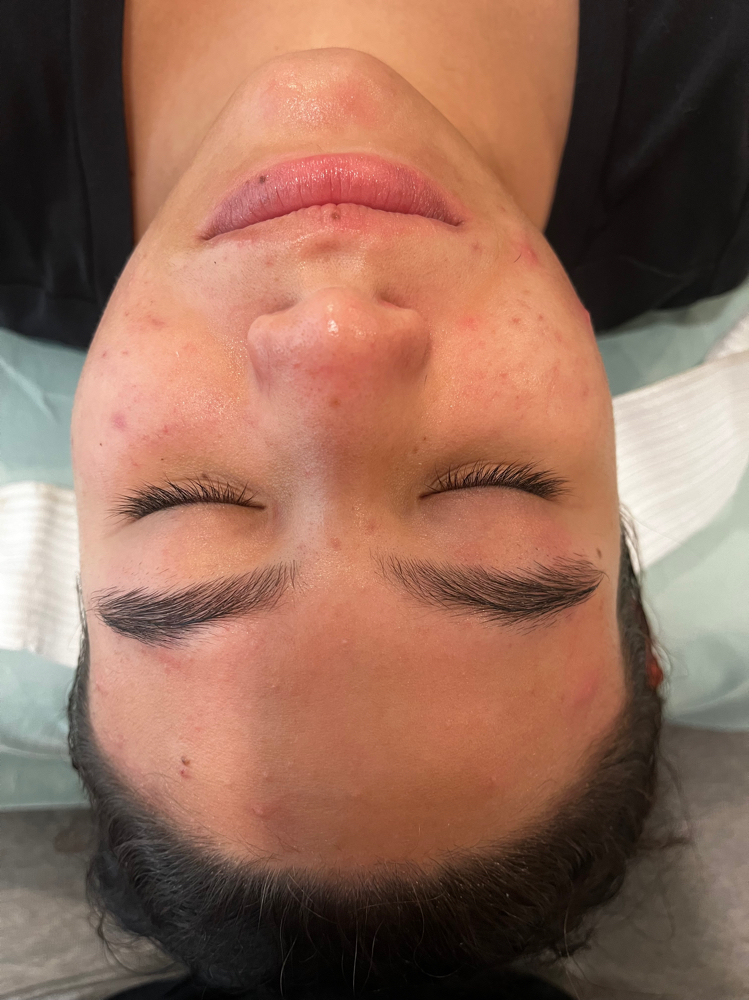 Acne Detox Facial