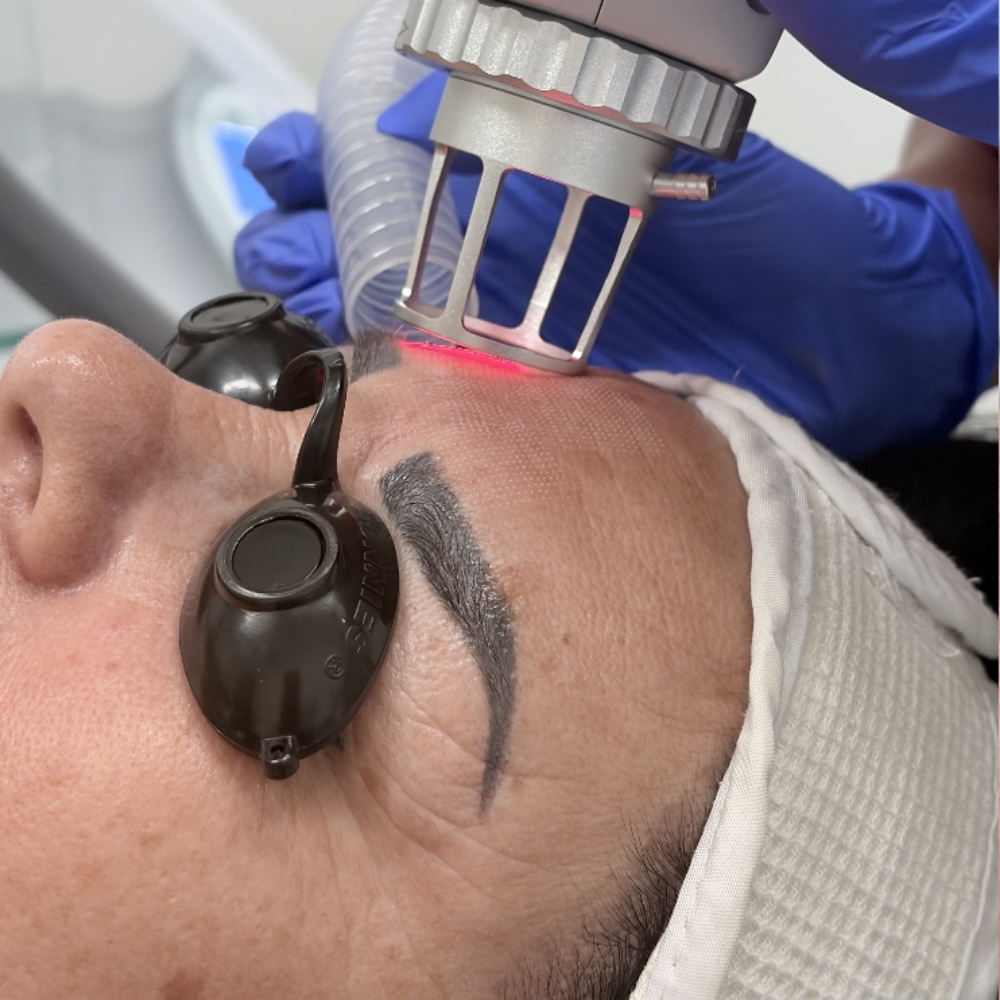 C02- Face Micropeel Promo($299) at Skin Commitment LLC in Brownsville Tx, TX