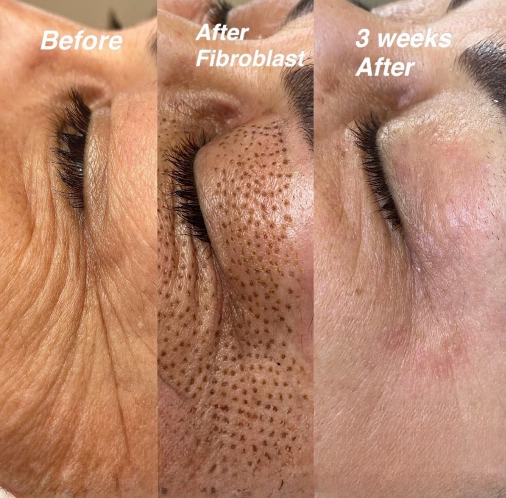 Eyelid Wrinkle Removal