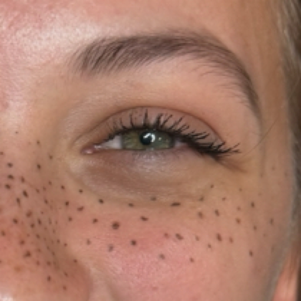 Freckles at Alex @ Blade Babes Aesthetics in Hernando, MS