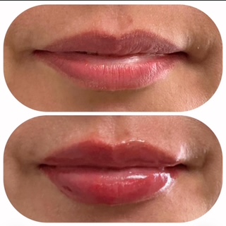 Dermal Filler