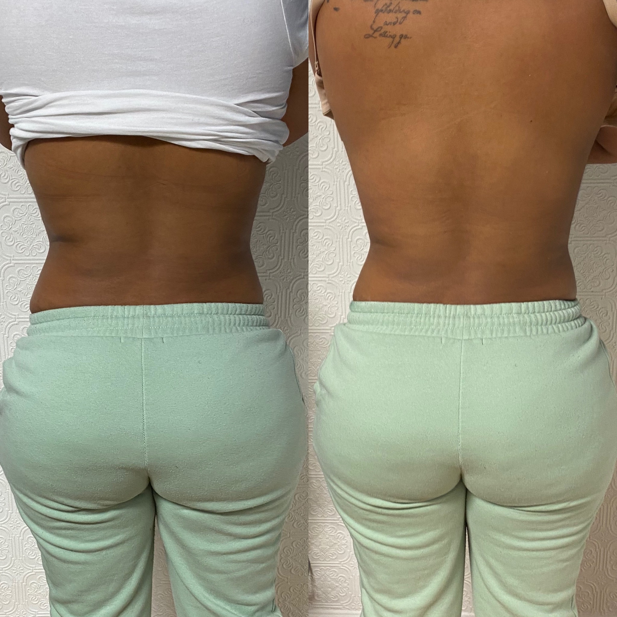 Skin Tightening