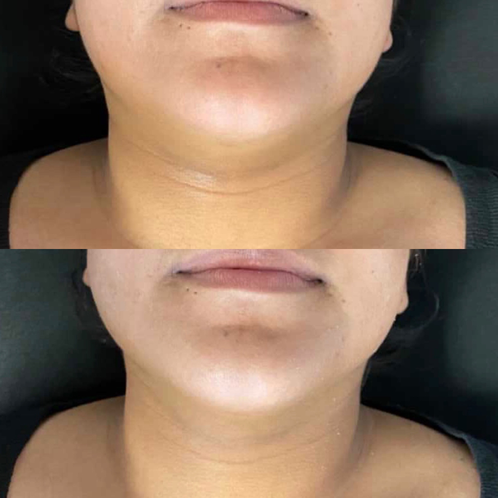 Facial Contouring