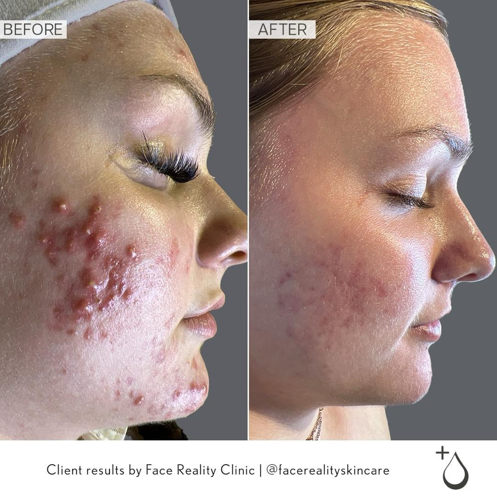 Acne Consult & Skincare Treatment
