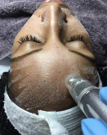 Crystal Microdermabrasion