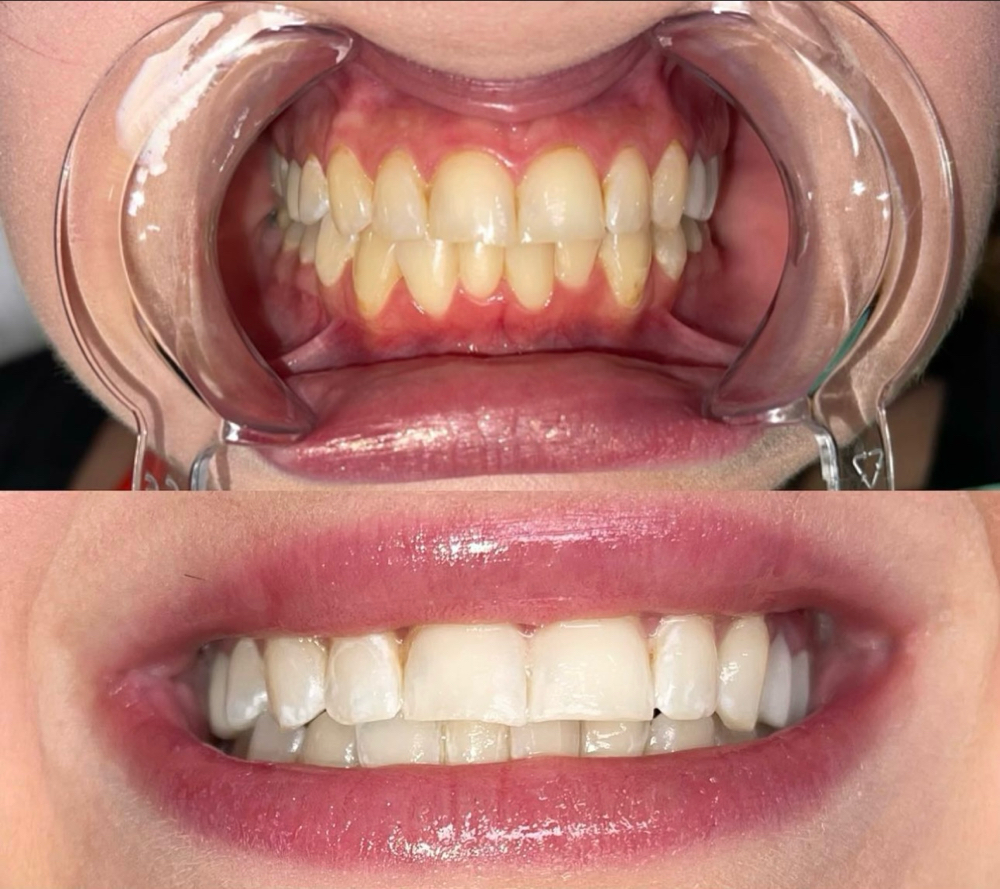 30 Min Teeth Brightening