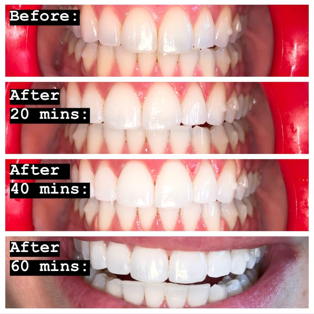 Teeth ✦ Brightening ✧
