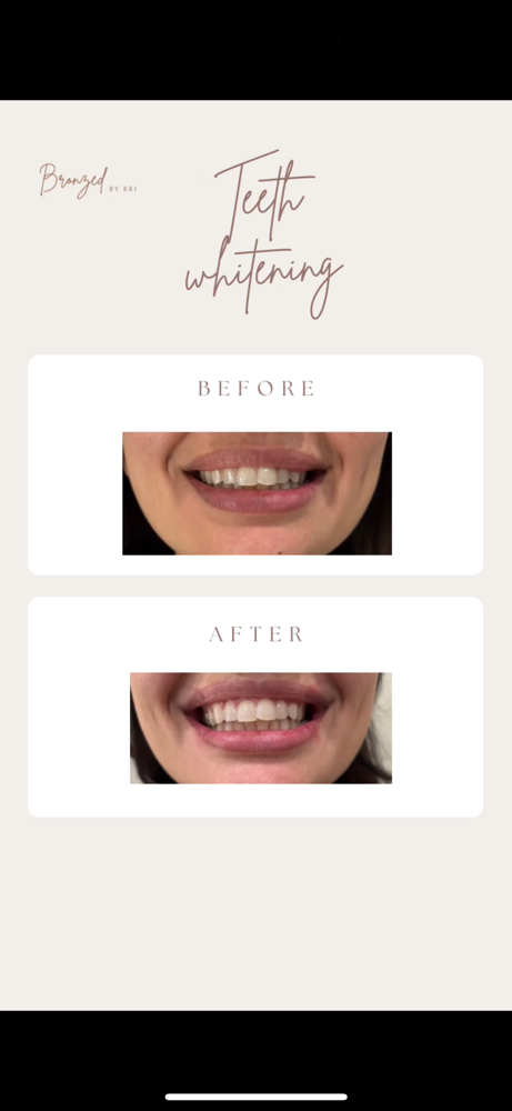 TUESDAY Teeth Whitening Treatment