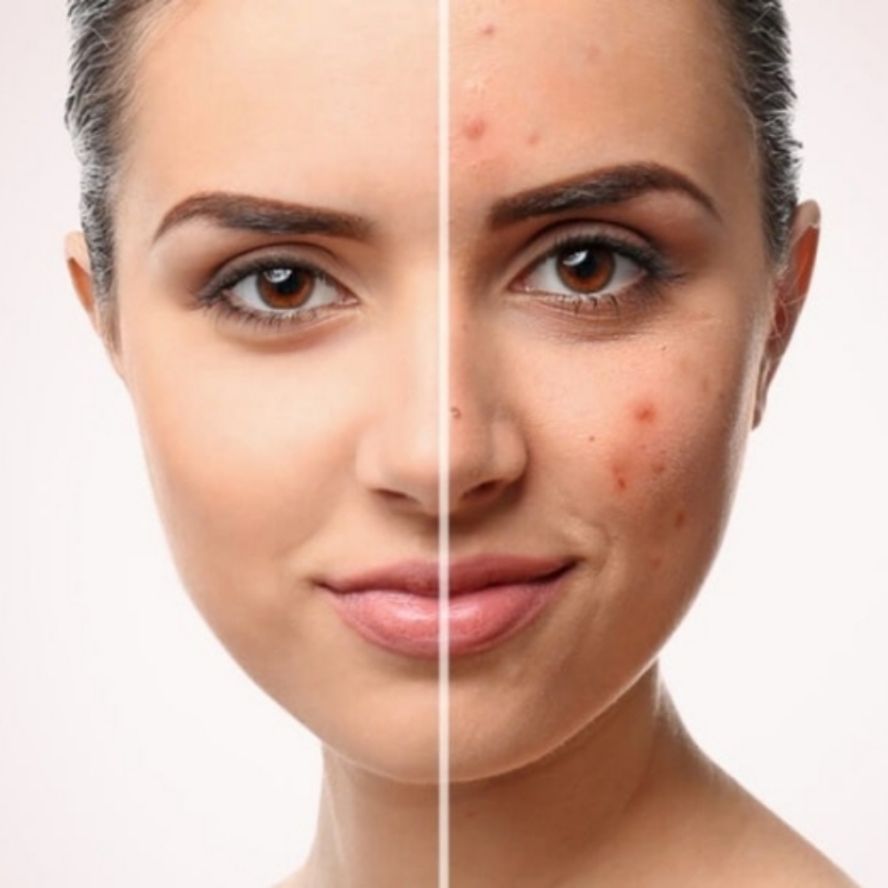 Acne Treatment at Serifium Skincare by Monica in Brownsville, TX