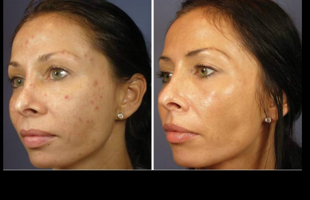 🟥2026 Morpheus8 + Microneedling RF