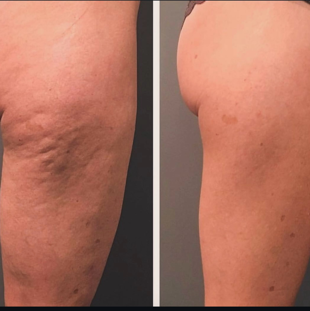 cellulite reduction/celulitis
