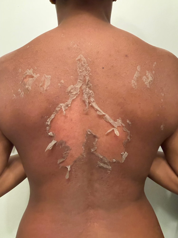 ALGAE PEEL (Back)