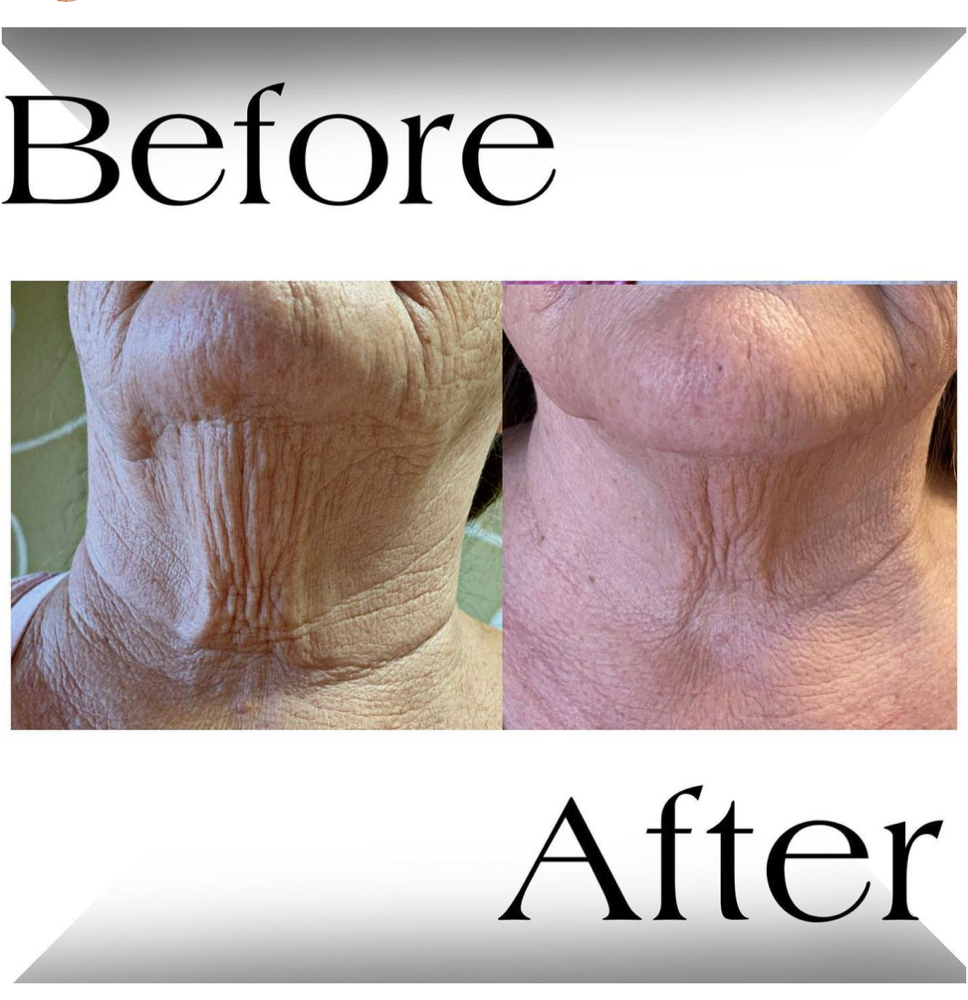 FULL NECK SKIN TIGHTENING