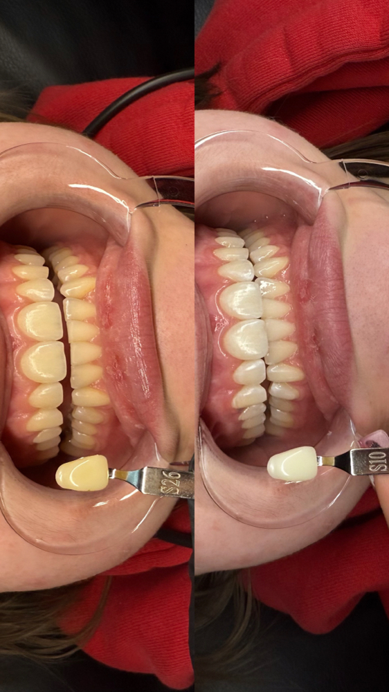 ✨Teeth Whitening 1Hr✨