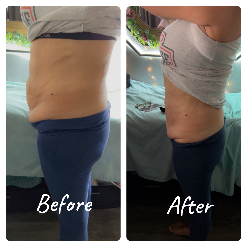Bundel Fat Dissovling & Laser Lipo