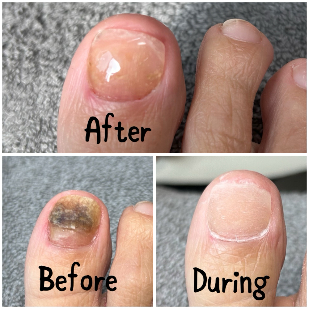 Big Toenail Restoration at Sole 2 Soul Spa in Wilmington, NC