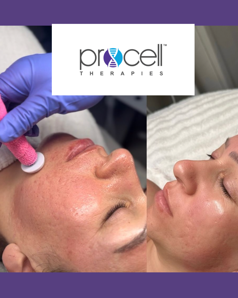 Microchanneling (1 Treatment) at Skin & Bare It Aesthetics and Bodywork in Triadelphia, WV