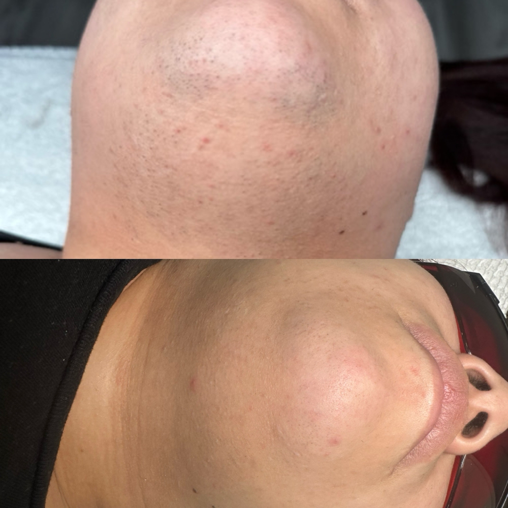FACE Laser Hair Removal
