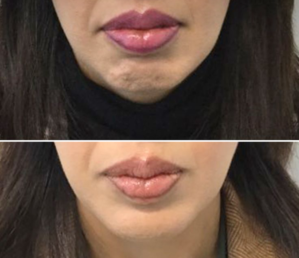 Smooth Chin Tox