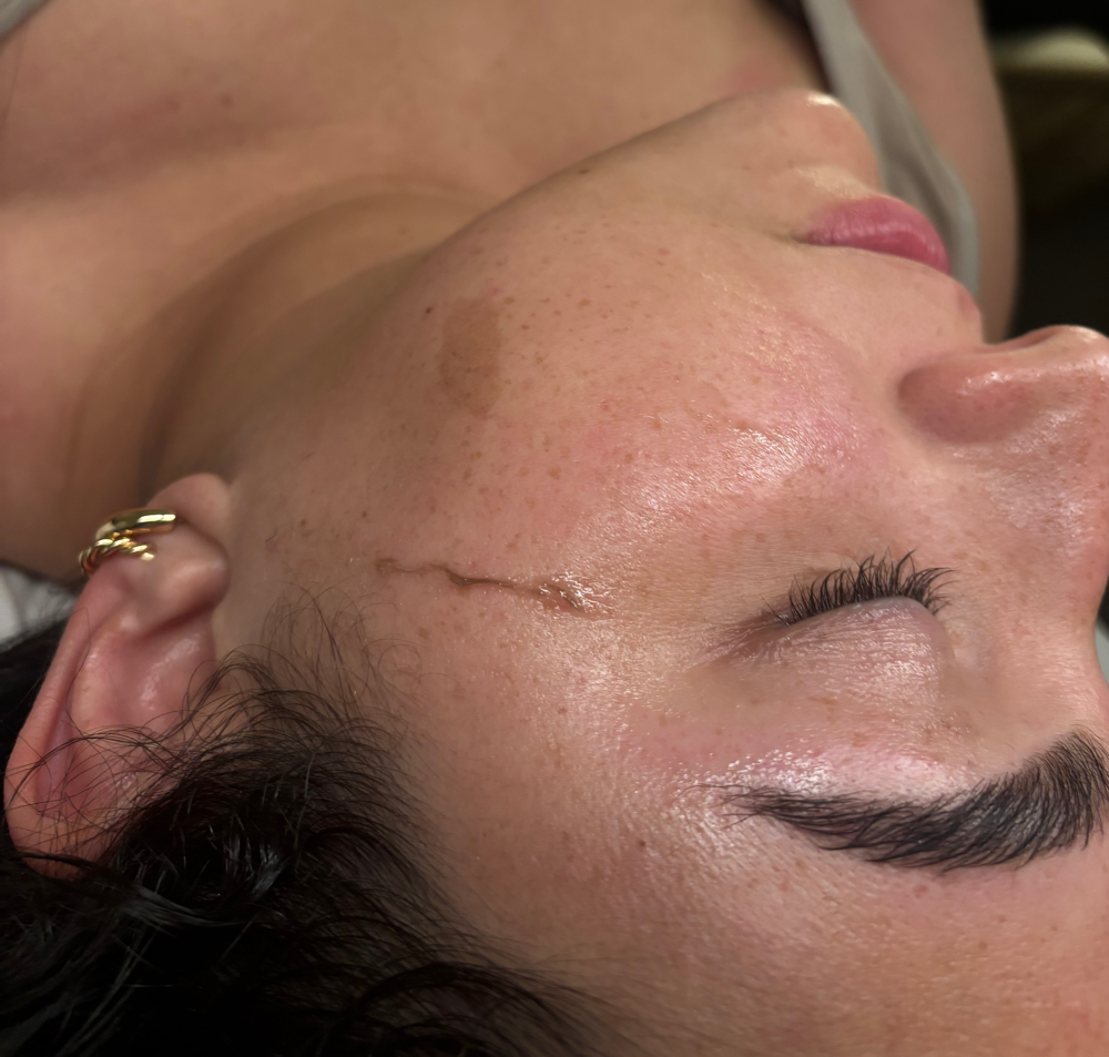 Dermaplaning at Radiant Skin Esthetics in Moline, IL