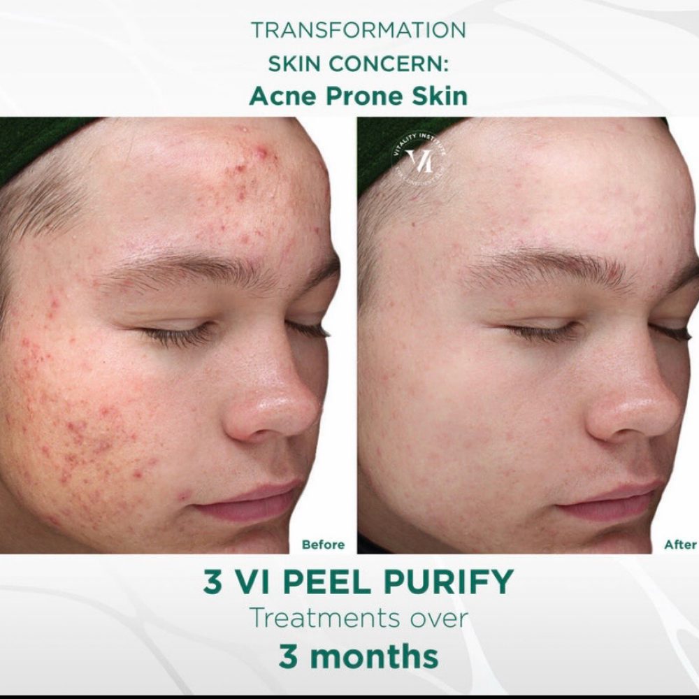 VI  Peel | Skin Renewal Treatment at Mily Aesthetics in Newark, NJ