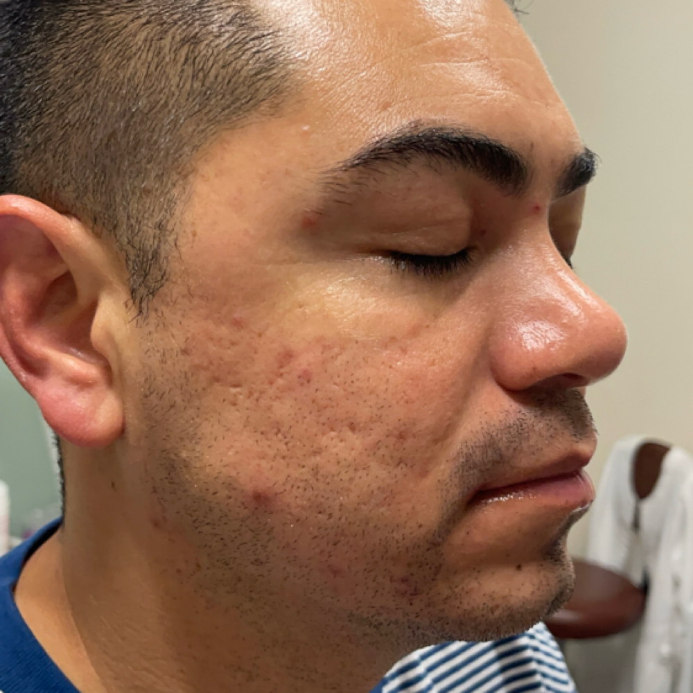 Clarifying Acne Facial at On The Brite Side Of Skin in Rancho Cucamonga, CA