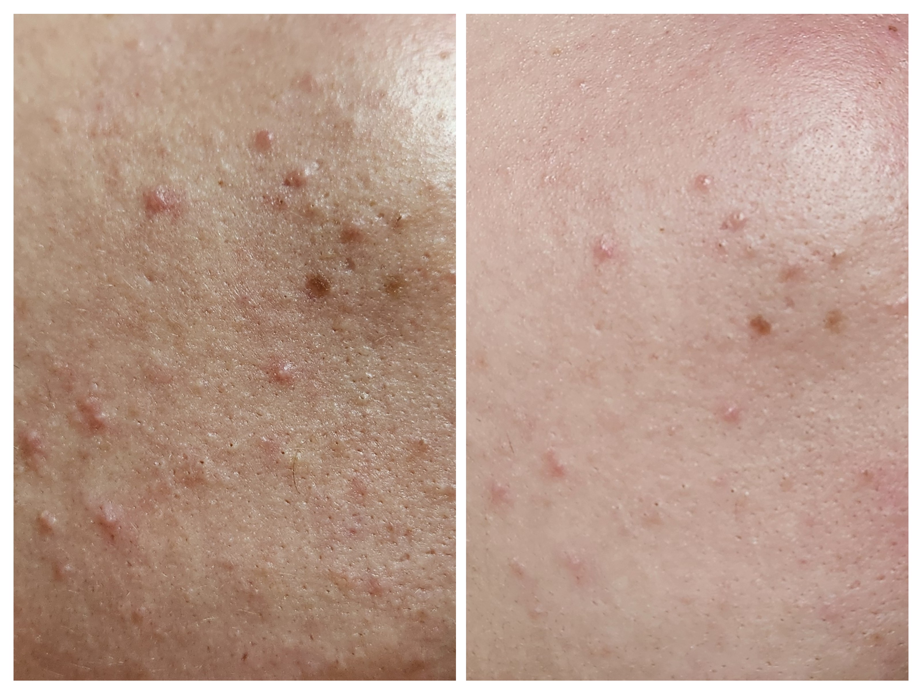 Ayurvedic Phyto LED Acne Treatment