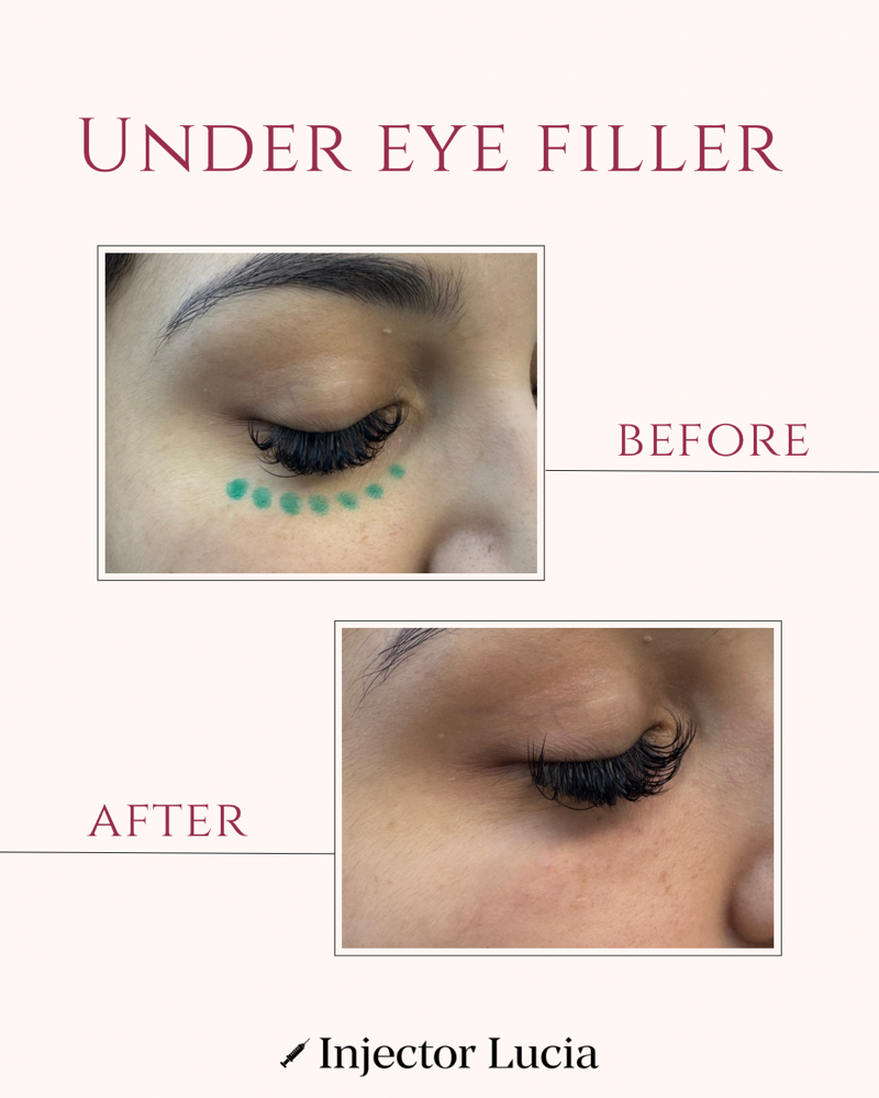 under eye filler