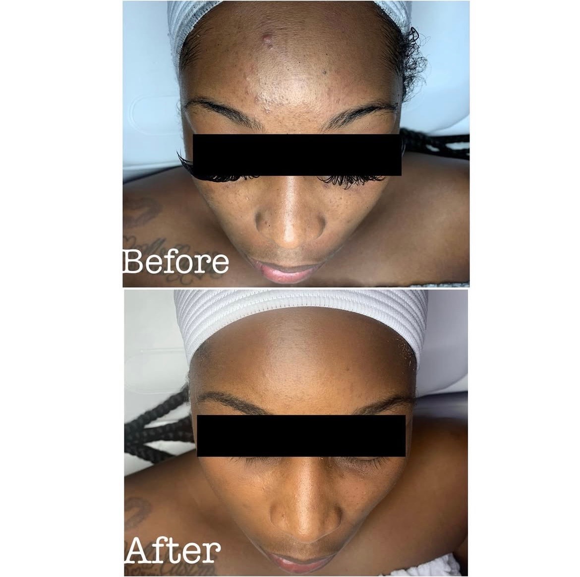 Hydra-facial