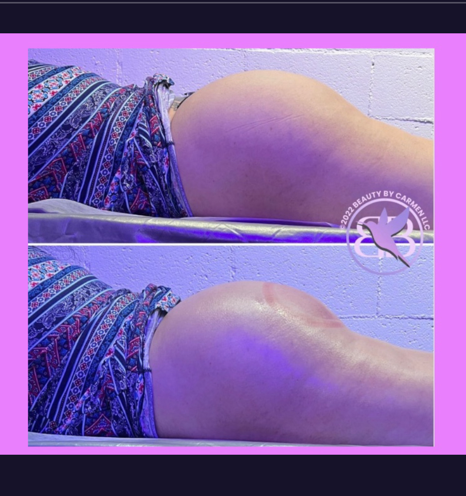 Non-Invasive Butt Lift