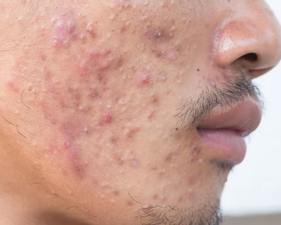 Acne Peel at Signature Skin Spa in Scottsdale, AZ