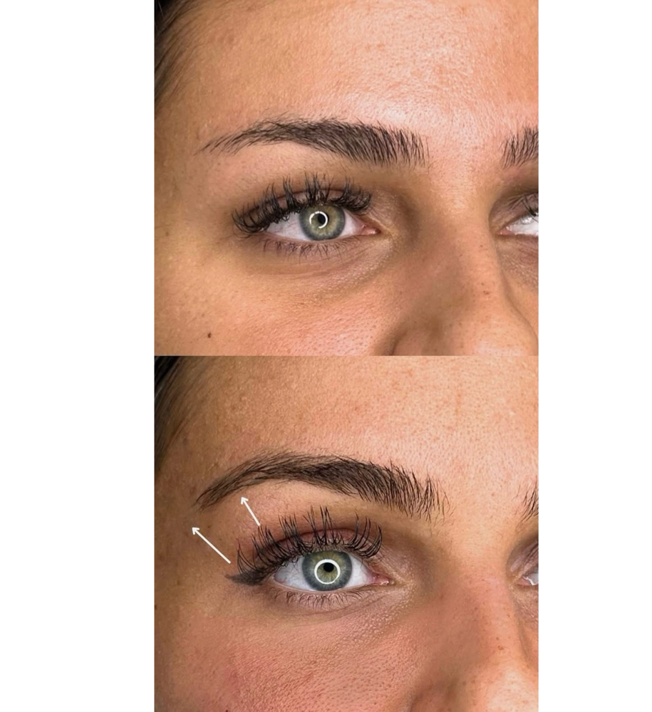 Brow Lift