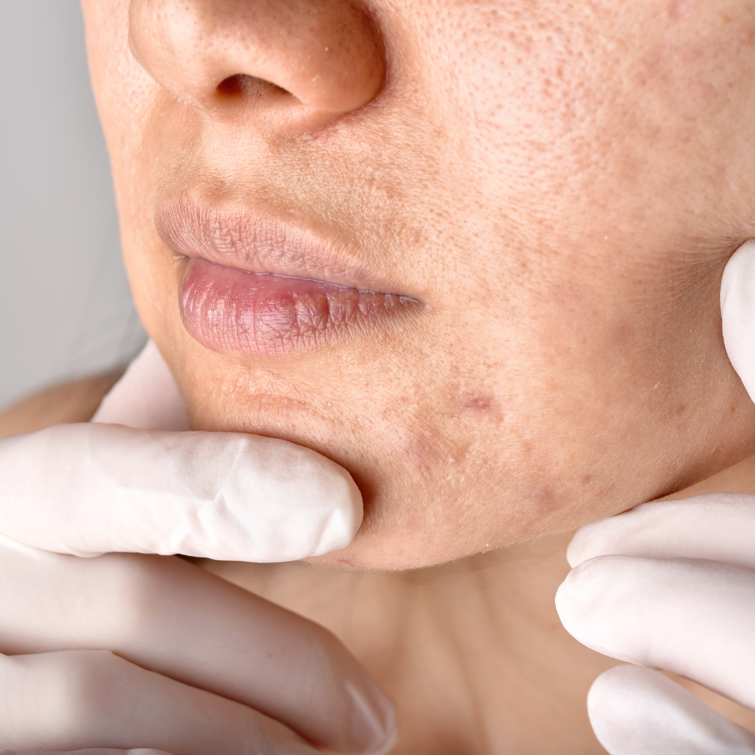 Bonna Acne-Focused FACIAL
