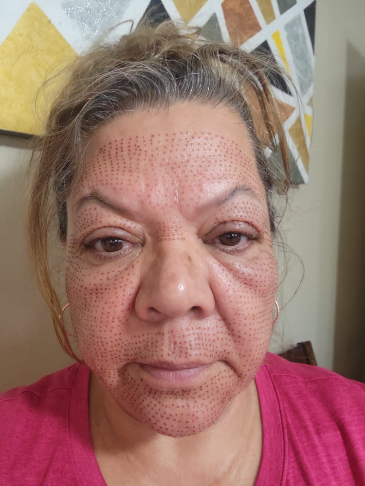 Fibroblast Skin at Leidy Cornelio Spa in Aurora, CO