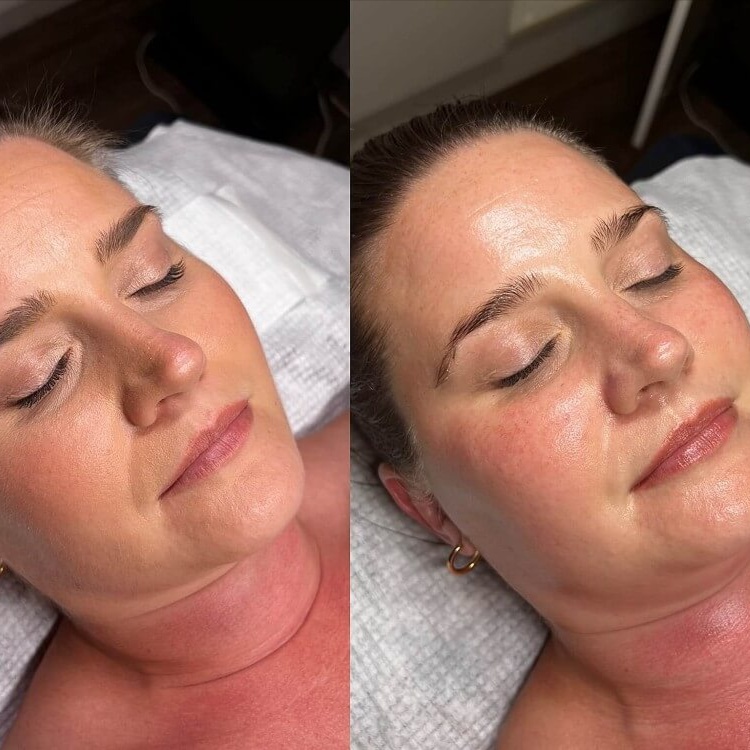 Facials - Hydration Boost at Unique Clinique Aesthetics in Brooklyn, NY