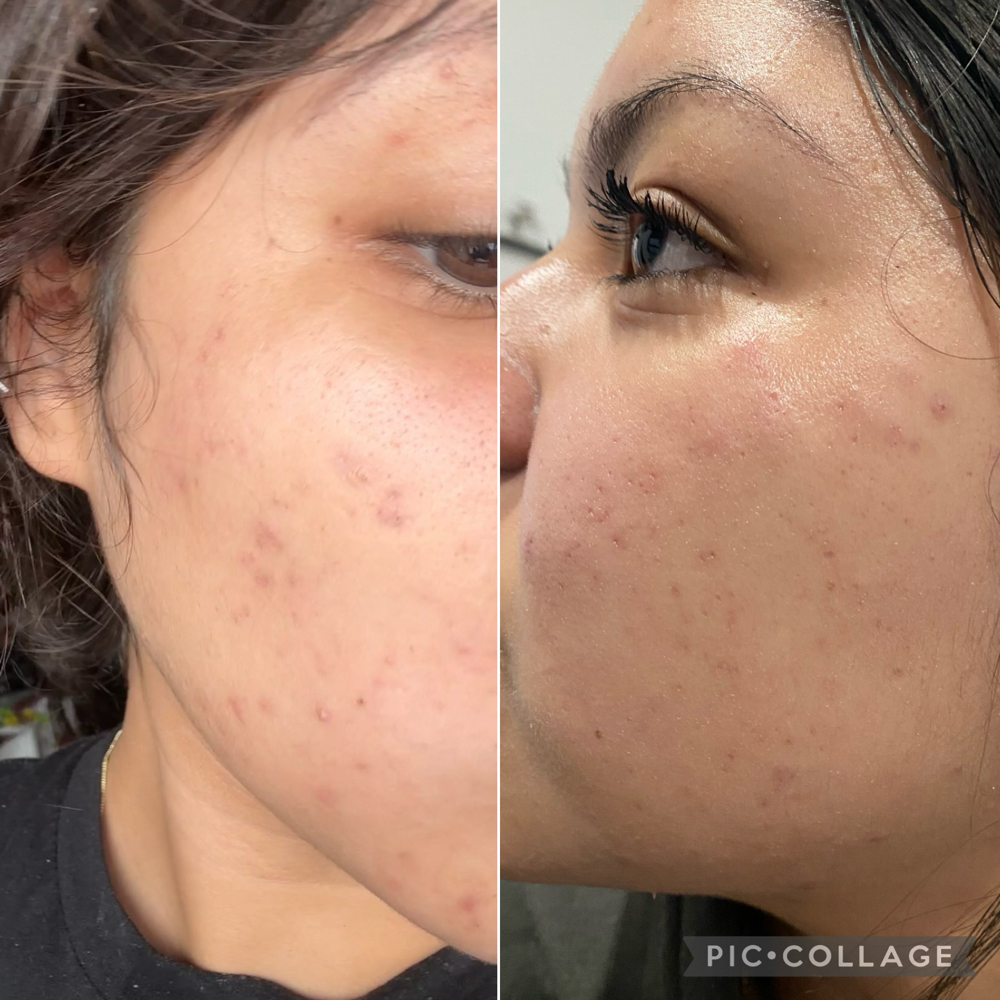Acne Facial