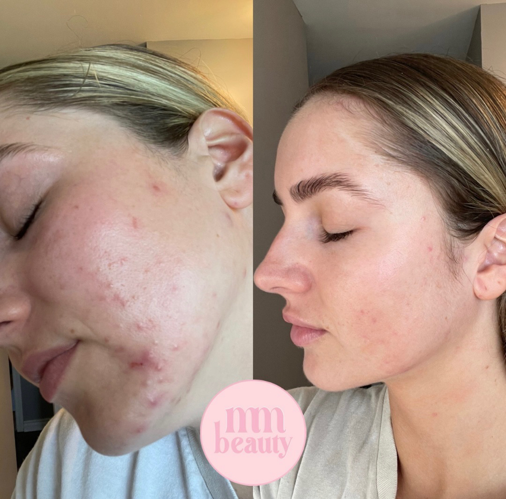 Acne Bootcamp Facial