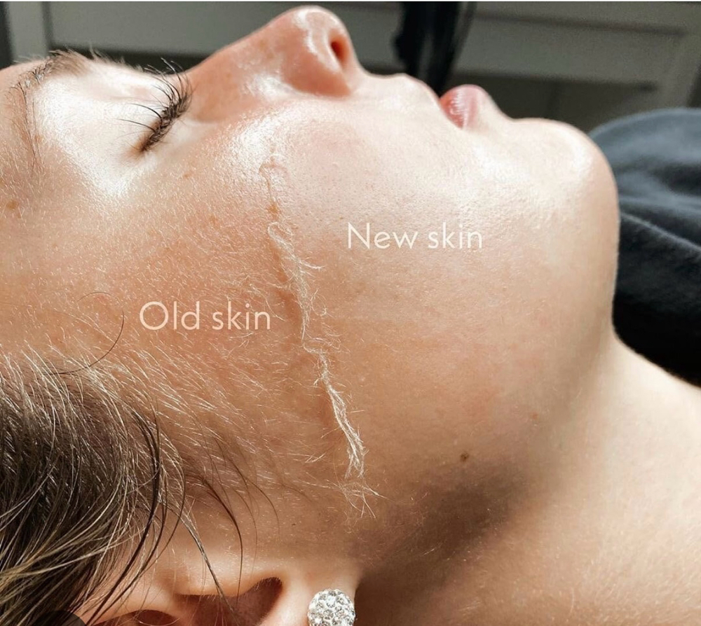 Dermaplane Facial
